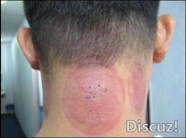 用针点刺“风疙瘩”出尽恶血 中风就不会发作 - 瀛子 - 瀛の小笺