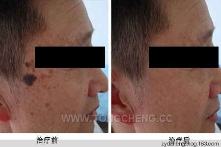 老人斑一发不可收！两茶饮告别斑 - 瀛子 - 瀛の小笺