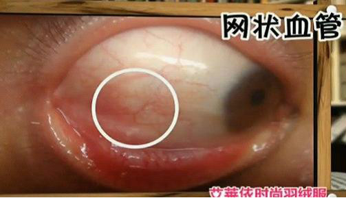 教大家目诊——通过看眼睛来预测疾病！ - 缘水禅心 - 