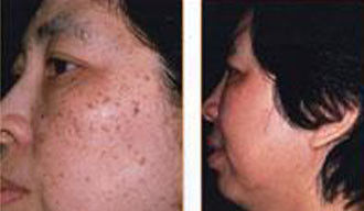 各种面斑--的有效治疗方法 - 高山予鹰 - 保健养生