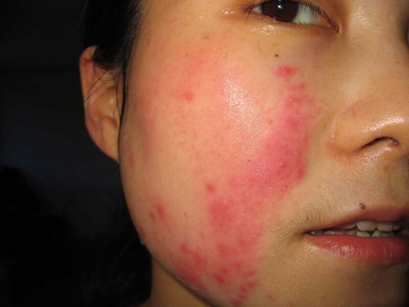 《根治各种皮肤顽疾偏方》 -   红杏妹 - 红杏妹