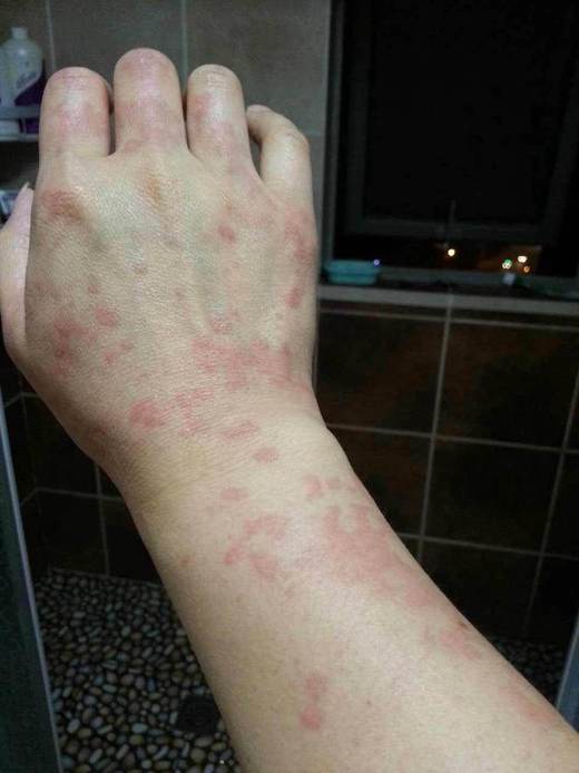 美乐家产品分享：神奇茶树精油！3小时减缓3天2夜荨麻疹症状