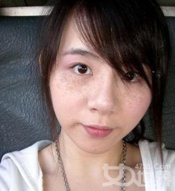 各种面斑--的有效治疗方法 - 高山予鹰 - 保健养生