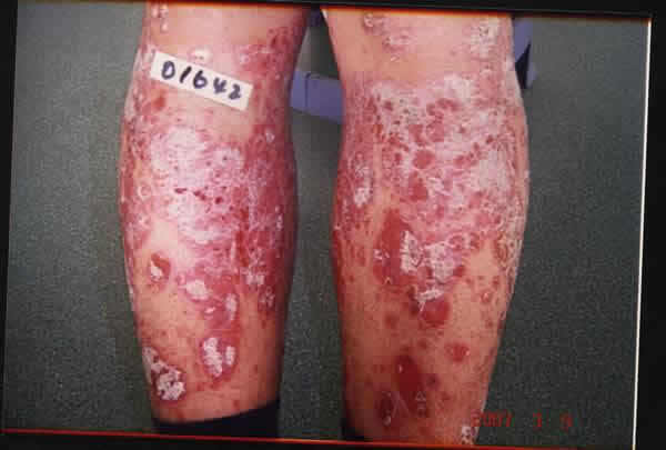 《根治各种皮肤顽疾偏方》 -   红杏妹 - 红杏妹