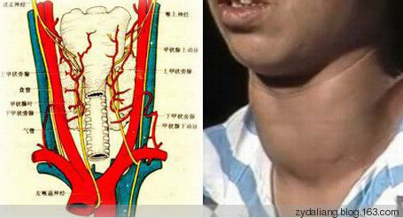 甲状腺肿大--已经治疗好11个患者 永不复发 - 瀛子 - 瀛の小笺