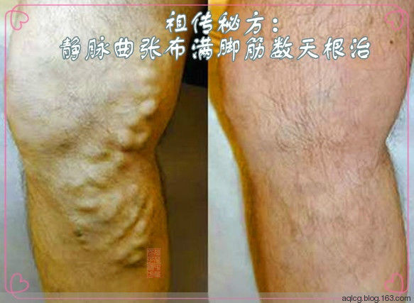 静脉曲张布满脚筋数天根治 - 汶水澄清 - 中医中药_养生保健_民间偏方_知识大全