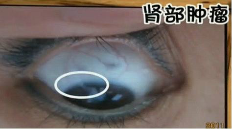 教大家目诊——通过看眼睛来预测疾病！ - 缘水禅心 - 