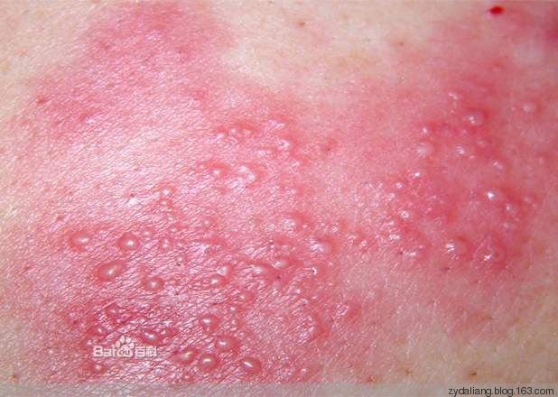 带状疱疹不可怕 五个绝招一分都不花 - 瀛子 - 瀛の小笺