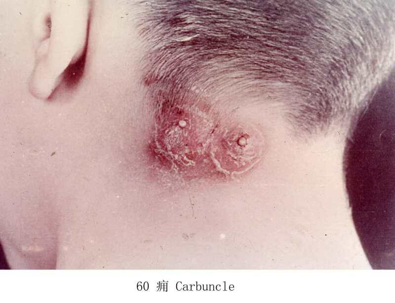 《根治各种皮肤顽疾偏方》 -   红杏妹 - 红杏妹