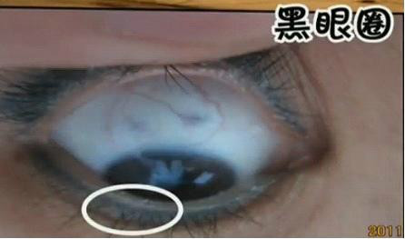 教大家目诊——通过看眼睛来预测疾病！ - 缘水禅心 - 