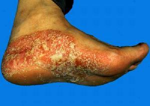 《根治各种皮肤顽疾偏方》 -   红杏 - 红杏