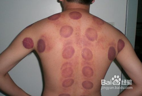 中医拔罐减肥法，掌握正确步骤速甩脂