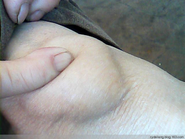 膝关节腔积液很有效的方子 - 瀛子 - 瀛の小笺