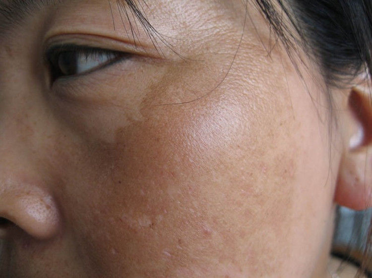 各种面斑--的有效治疗方法 - 高山予鹰 - 保健养生