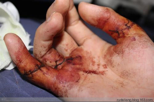 刀伤药极效方，一次即愈 - 瀛子 - 瀛の小笺