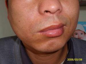 治口眼歪斜立愈方