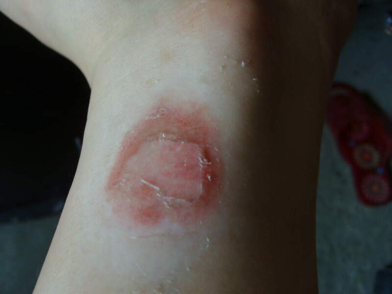 《根治各种皮肤顽疾偏方》 -   红杏妹 - 红杏妹