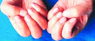 观指甲知健康：光泽油亮或患急性传染病(图)