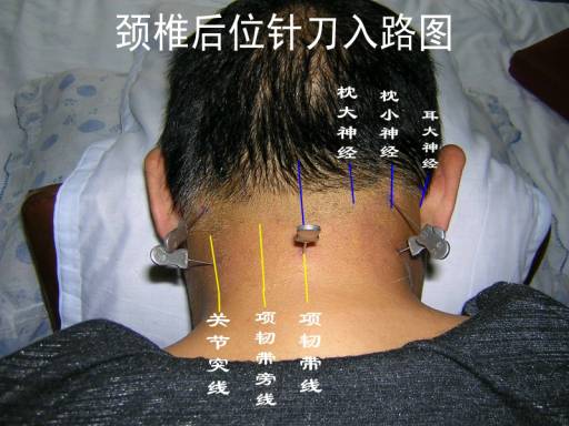 转颈椎病的辨位诊断和针刀操作技巧