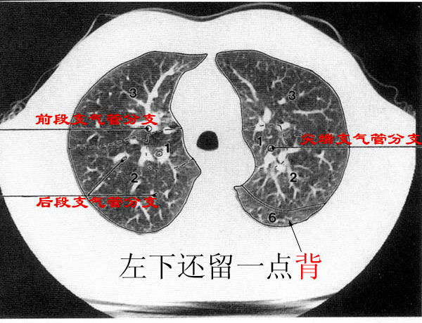 ct肺分页肺窗