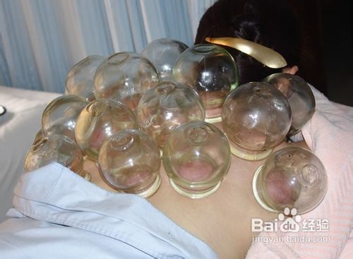 中医拔罐减肥法，掌握正确步骤速甩脂