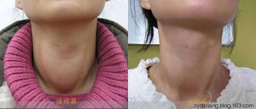 甲状腺肿大--已经治疗好11个患者 永不复发 - 瀛子 - 瀛の小笺