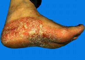 《根治各种皮肤顽疾偏方》 -   红杏妹 - 红杏妹