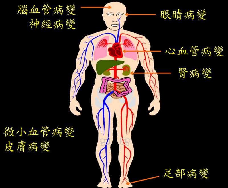 糖尿病是怎样患上的