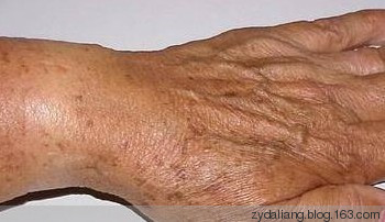 老人斑一发不可收！两茶饮告别斑 - 瀛子 - 瀛の小笺