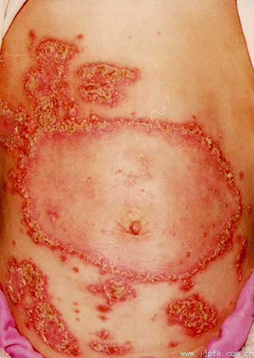 《根治各种皮肤顽疾偏方》 -   红杏妹 - 红杏妹