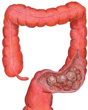 most cancers du foie grade three