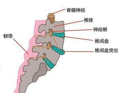 腰椎间盘突出症